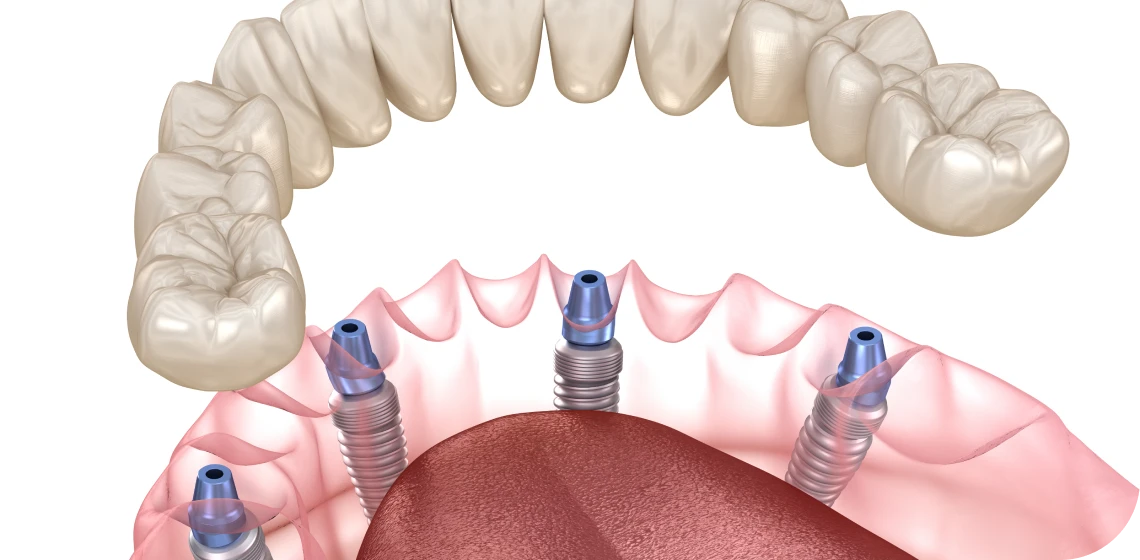 all-on-4-6-centre-implantologie-teintureries-tarare