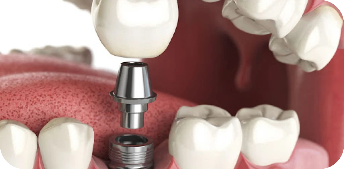 mise-en-charge-immediate-centre-implantologie-teintureries-tarare