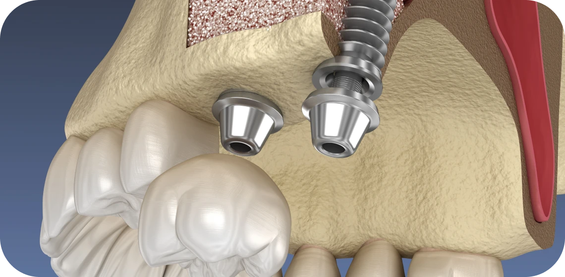 sinus-lift-centre-implantologie-teintureries-tarare