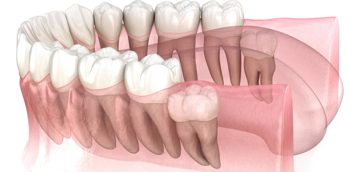 dents-sagesse-drs-poulet-lacroix-dentistes-tarare