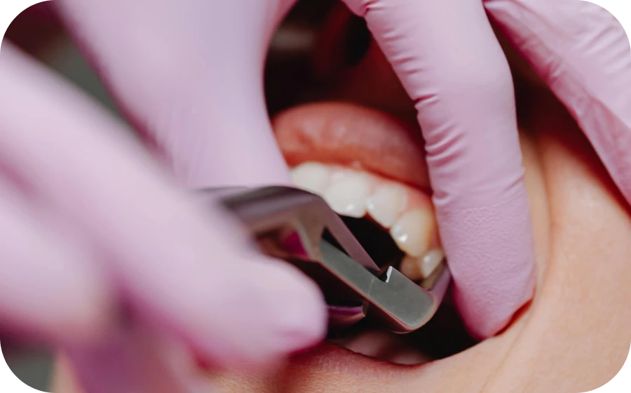 extraction dentaire centre implantologie teintureries tarare Extraction dentaire Centre d’implantologie des Teintureries