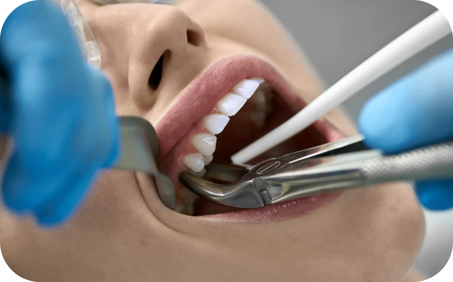 extraction implantation immediate centre teintureries tarare Extraction implantation immédiate Centre d’implantologie des Teintureries