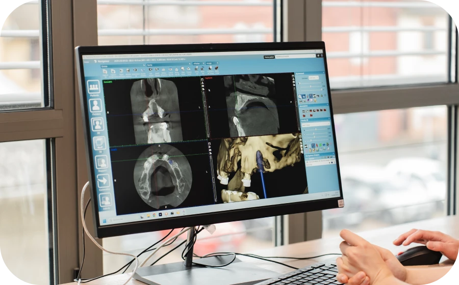 mise en charge immediate centre implantologie tarare Mise en charge immédiate Centre d’implantologie des Teintureries