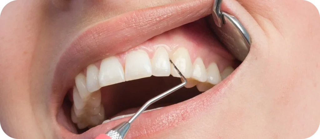 parodontologie dentistes centre teintureries tarare Parodontologie clinique Centre d’implantologie des Teintureries