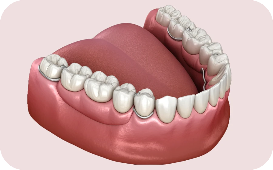 prothese plurale amovible centre implantologie teintureries tarare Prothèse plurale Centre d’implantologie des Teintureries