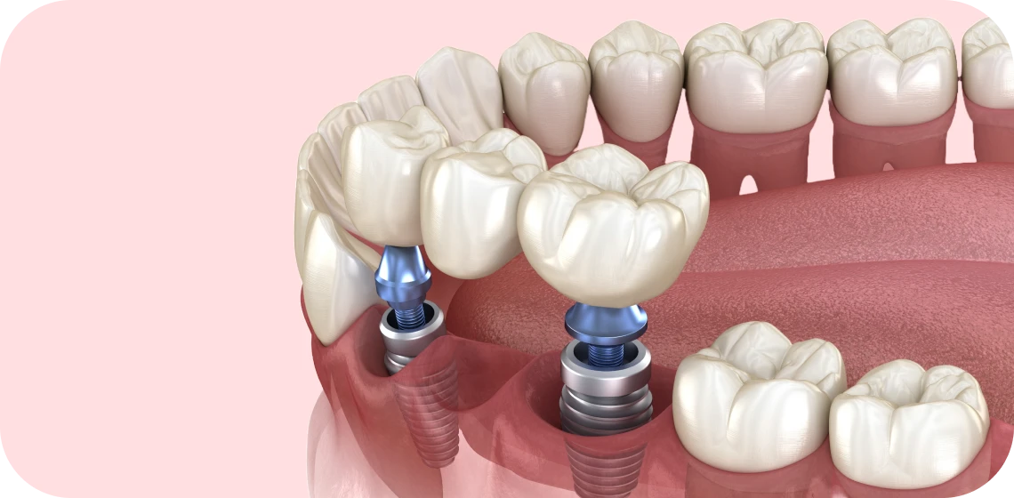 prothese-sur-implant-teintureries-tarare