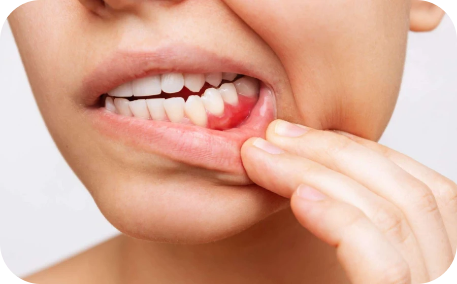 signes maladies parodontales Parodontologie clinique Centre d’implantologie des Teintureries